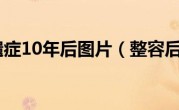 整容后遗症10年后图片（整容后遗症）